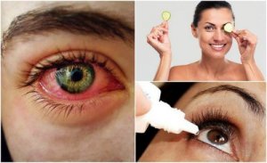 Kuru Göz Sendromu: Doğal Yollarla Nasıl Savaşırsınız