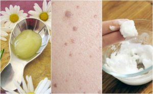 Yassı Siğillerden Kurtulmak İçin 5 Tedavi