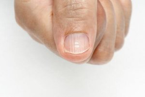 Tırnak Üzerindeki Çizgiler: Sebepleri Nelerdir?