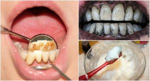 Diş Taşları İçin 3 Etkili Tedavi Yöntemi