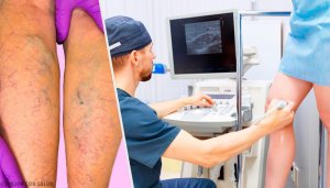 Varis İçin Topikal ve Oral Doğal Tedavi Yöntemleri