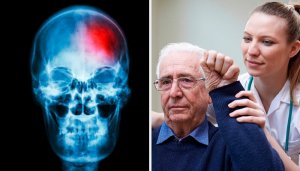 Geçici İskemik Atak (Mini Felç) Nedir?