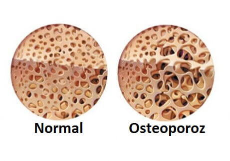 osteoporoz