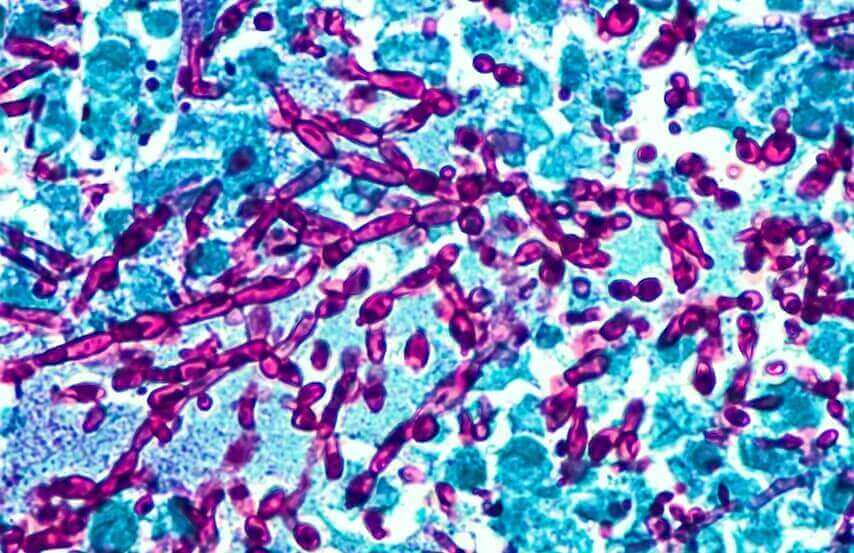 vajinal enfeksiyonların çeşitleri ve nedenleri