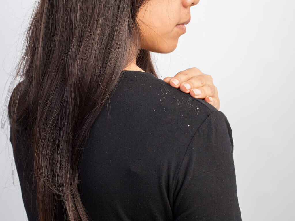 kepekli saçı olan kadın