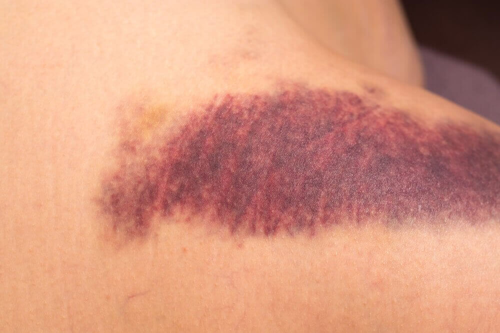 purpura