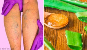 Varisli Damarlar: Bu Aloe Vera Çaresiyle İyileştirin