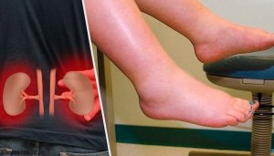 Ödem ve Su Tutumu Neden Olur?