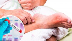 Yüksek Ürik Asit: 5 Yaygın Nedeni