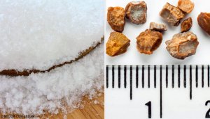 Böbrek Taşlarından Kurtulmak İçin 7 Ev Yapımı Reçete