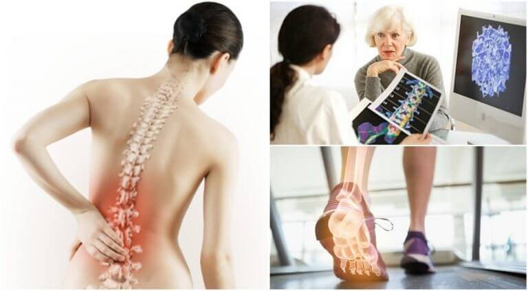 Osteoporoz Hakkında Bilmeniz Gereken 6 Gerçek