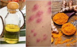 Kıl Folikülü Enfeksiyonuna Çözümler: 5 Ev Tedavisi