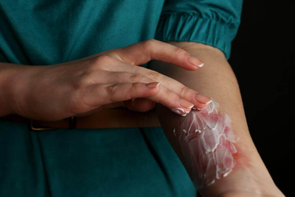 yanığa krem sürmek