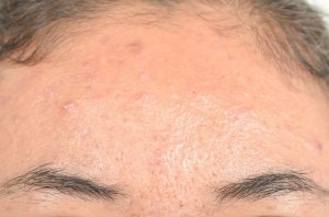 Seboreik Dermatit İçin Etkili Doğal Tedaviler