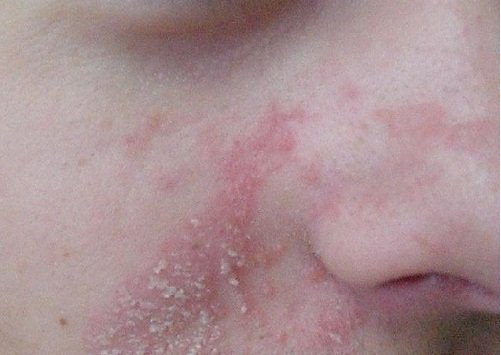 yüzde oluşan yaralar