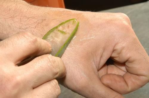 aloe vera yaraları iyileştirir