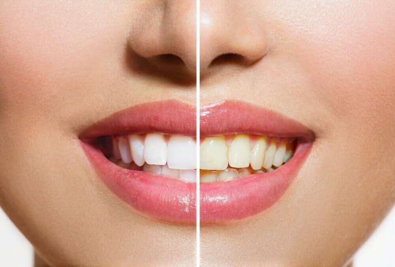Dişlerinizi Beyazlatmaya Yardımcı Doğal Ürünler