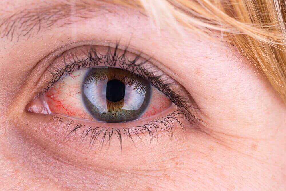 pembe göz hastalığı