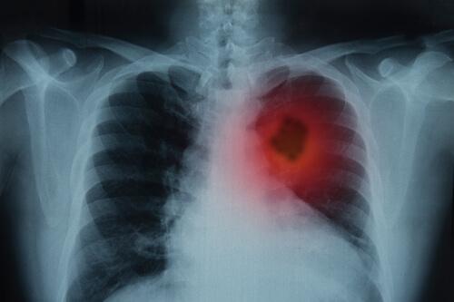 akciğer röntgeni