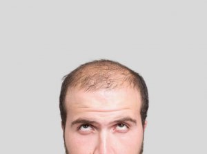 Kelleşme Problemi için Başvurabileceğiniz 3 Doğal Çare
