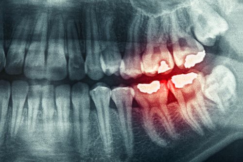 diş sıkma röntgen