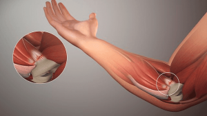 Tendon İltihaplanması İçin Doğal Çözümler