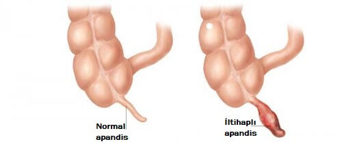 normal ve iltihaplı apandis