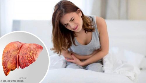 siroz hastası kadın