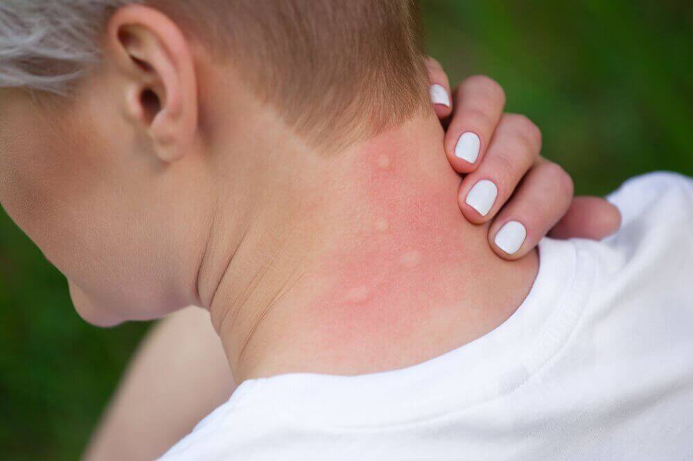 Sinek Isırıklarından Kaynaklanan Alerjileri Bu 5 Doğal Tedaviyle Dindirin