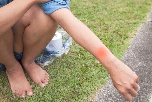 büyük boy sinek ısırığı