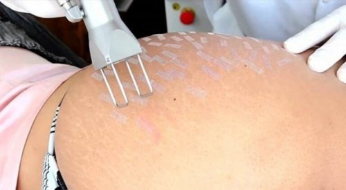 çatlaklar için tedaviler