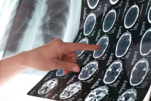 Felci Önlemek için 6 Yardımcı İpucu