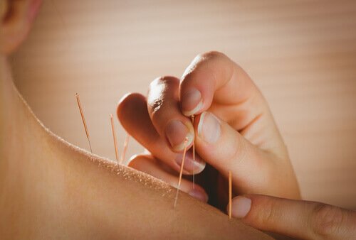 akupunktur