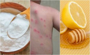 5 Ev Çaresi İle Pire Isırıklarını Rahatlatın