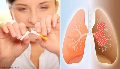 Akciğer Kanserinin Nedenleri Ve Teşhisi
