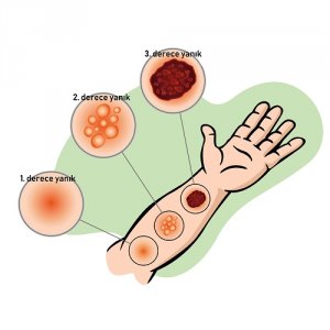 Yanıklar İçin Karbonat Nasıl Kullanılır?
