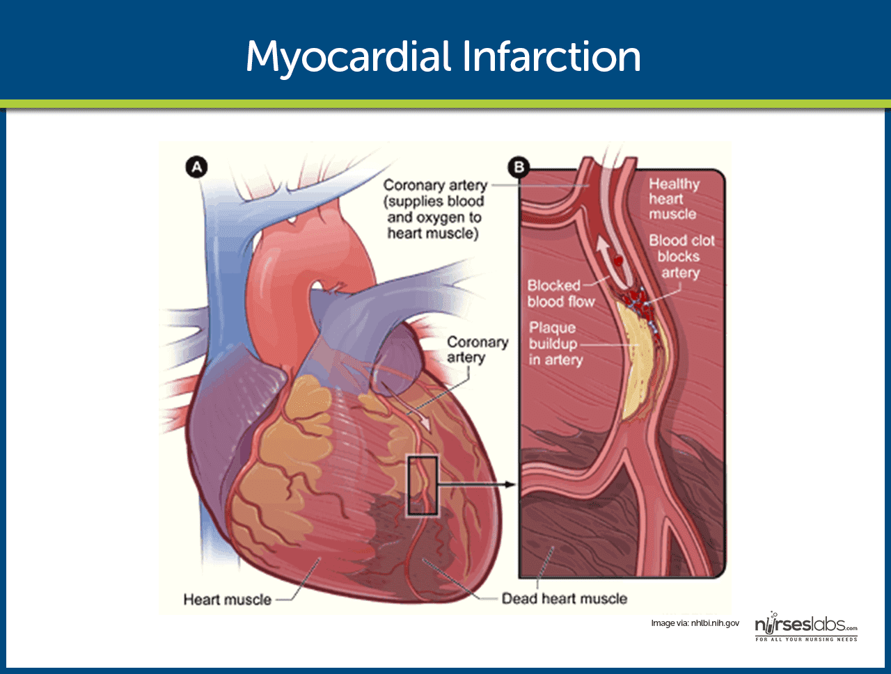 kalp krizi nasıl anlaşılır