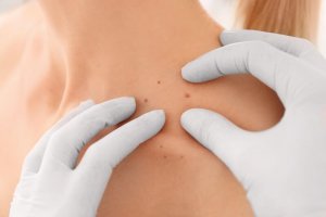 Beslenmeyle Siğilleri Önleme ve Tedavi Etme Yolları