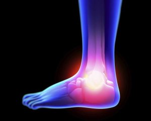 Burkulma Semptomlarını Doğal Olarak Tedavi Etmek