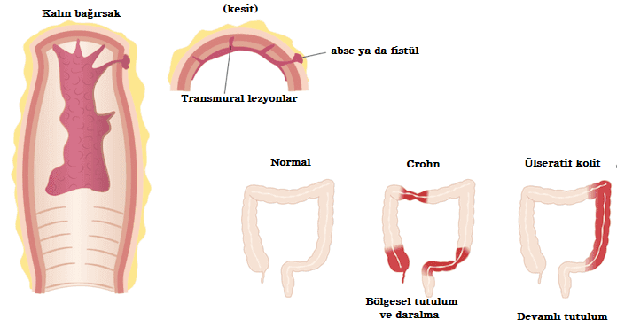 crohn hastalığı açıklayıcı görseli