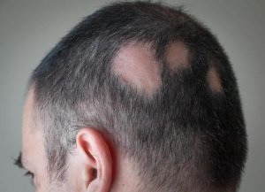 Doğal Çözümlerle Alopesi İle Nasıl Savaşılır?
