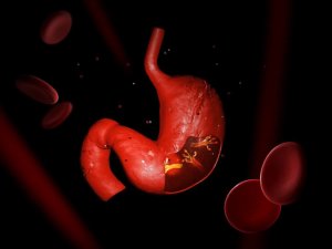 Helikobakter Pilori Enfeksiyonu İle Savaşmak İçin Bitkisel Çözümler