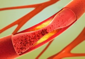 Arterlerinizin Sağlığını Nasıl Korursunuz