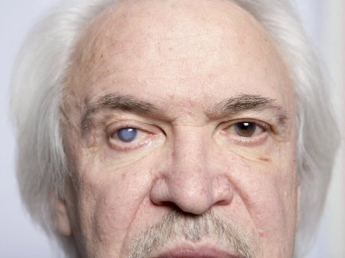 tek gözü katarakt olmuş adam