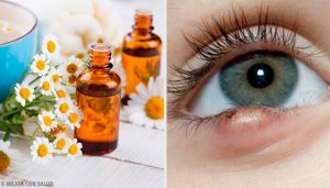 Arpacığı Tedavi Etmek İçin 5 Kolay Yöntem