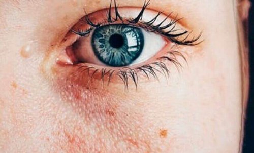 mavi göz göz altı hasar cilt