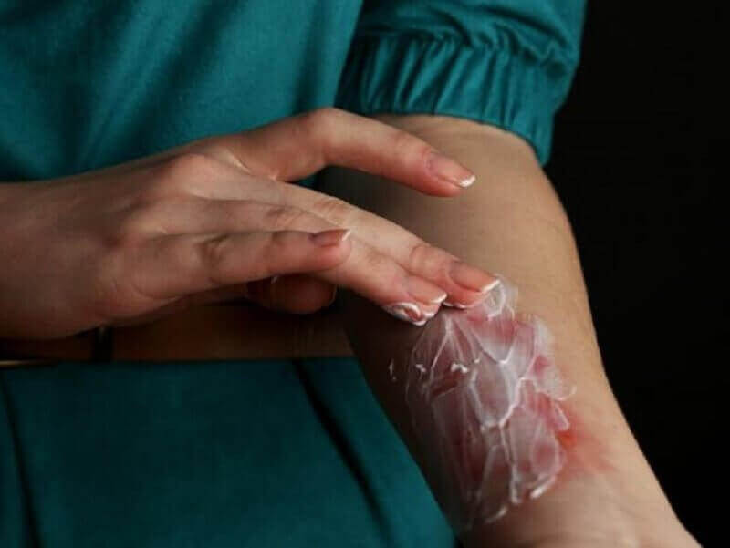 yanığa yoğurt sürmek