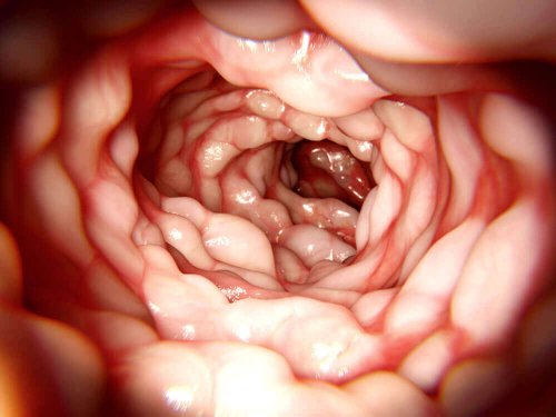 crohn hastalığı