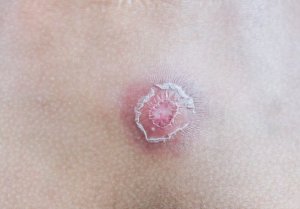 Çıban Nedir? Onlardan Kurtulmak İçin 7 İpucu