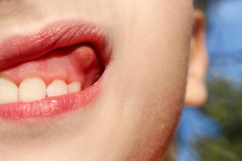 Dişteki Apseleri Tedavi Edecek 10 Yöntem